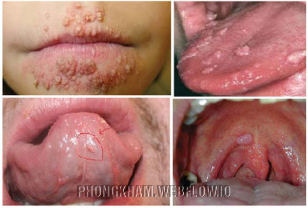 Hình ảnh viêm loét miệng họng