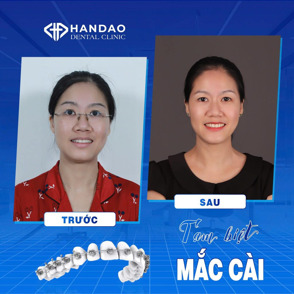 Khách hàng trải nghiệm hành trình niềng răng tại Nha khoa Hân Đào