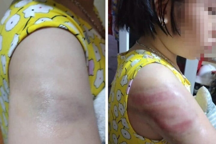 Vết bầm trên vai học sinh, minh họa sự việc cần được xử lý nghiêm minh tại trường Hồ Tùng Mậu 8Day - trang web uy tín đăng ký & đăng nhập dễ dàng
