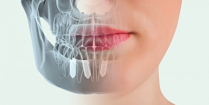 Hình ảnh quy trình thăm khám trước khi trồng răng implant tại 8Day - trang web uy tín đăng ký & đăng nhập dễ dàng