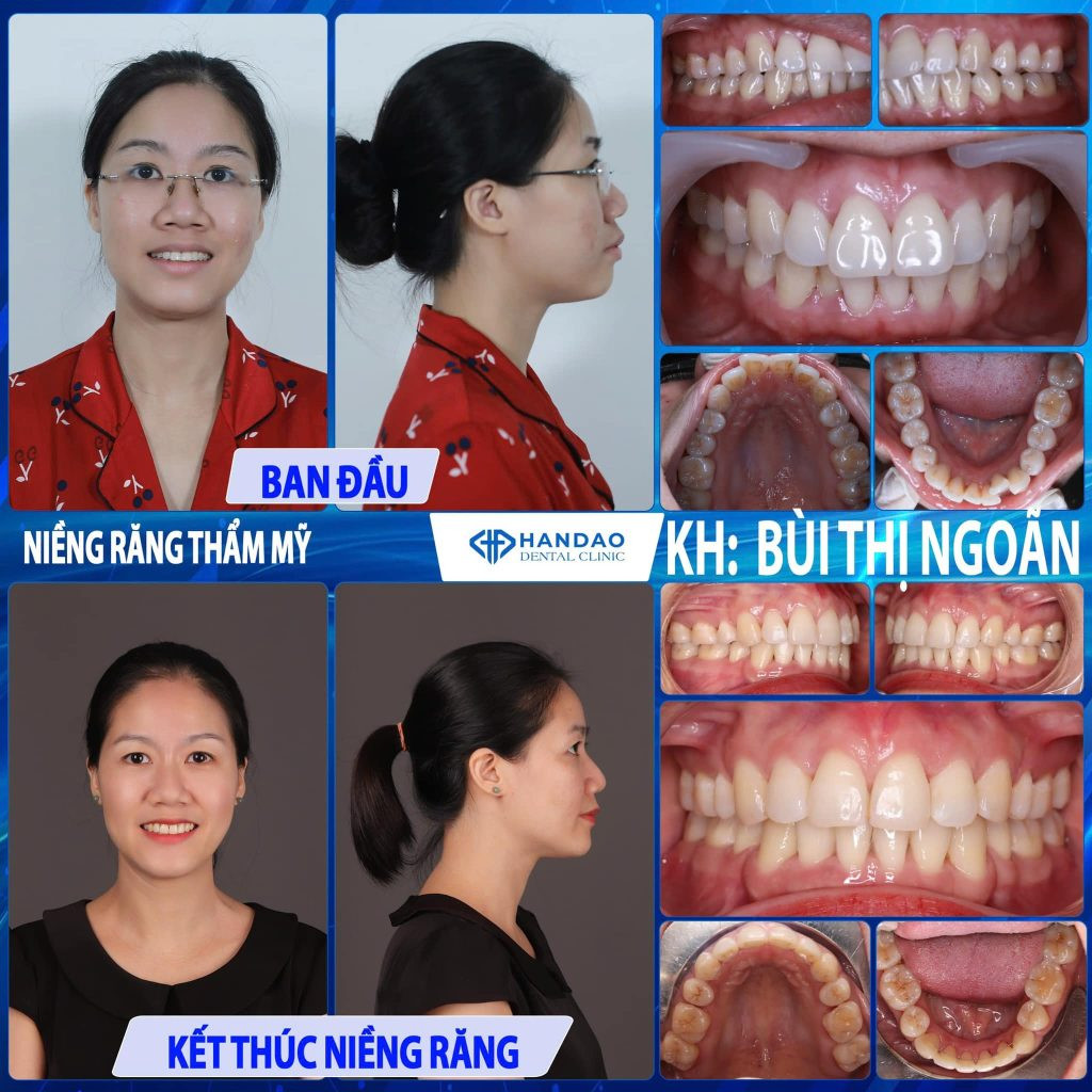 Kết quả nụ cười rạng rỡ sau điều trị tại phòng khám Nha Khoa Hân Đào 8Day - trang web uy tín đăng ký & đăng nhập dễ dàng