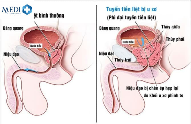 Tìm hiểu các nguyên nhân cần khám chữa tiểu buốt ở nam giới